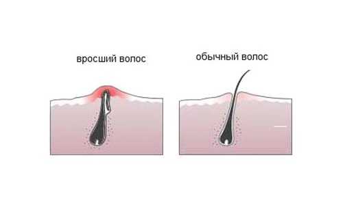 Как избавиться от вросших волос