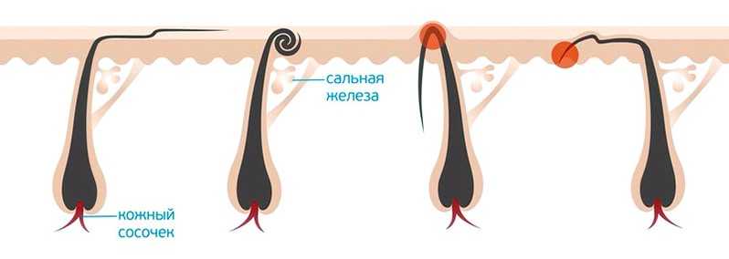 Как окончательно остановить рост волос с помощью восковой эпиляции?