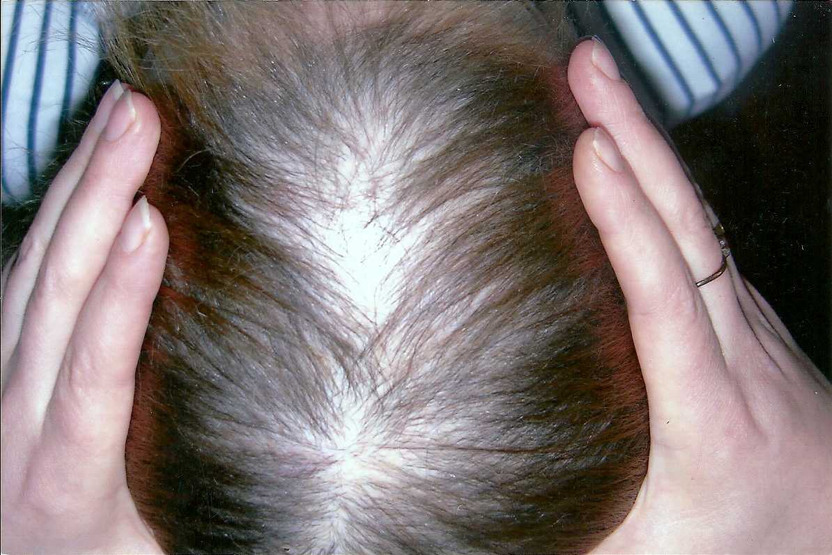 Выпадение волос у 30-летних женщин: причины и методы борьбы
