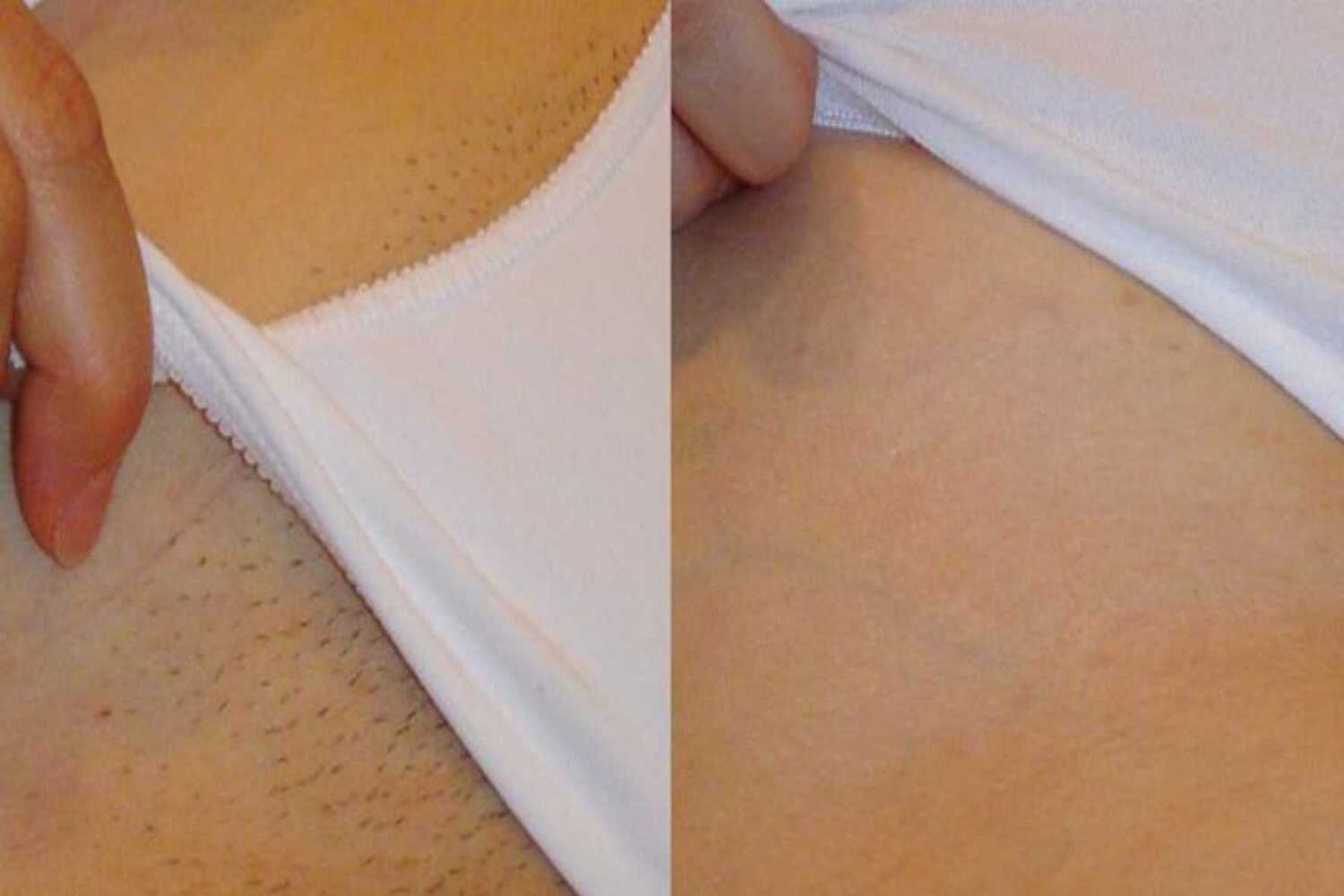 Знакомьтесь, новый тренд: спа-процедуры для кожи в области бикини 