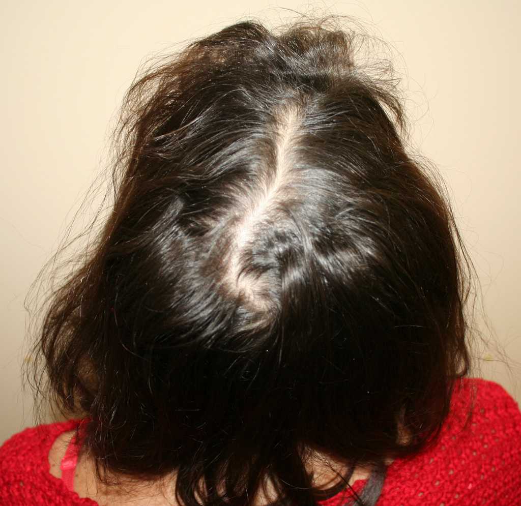 Основные причины выпадения волос у женщин у мужчин
