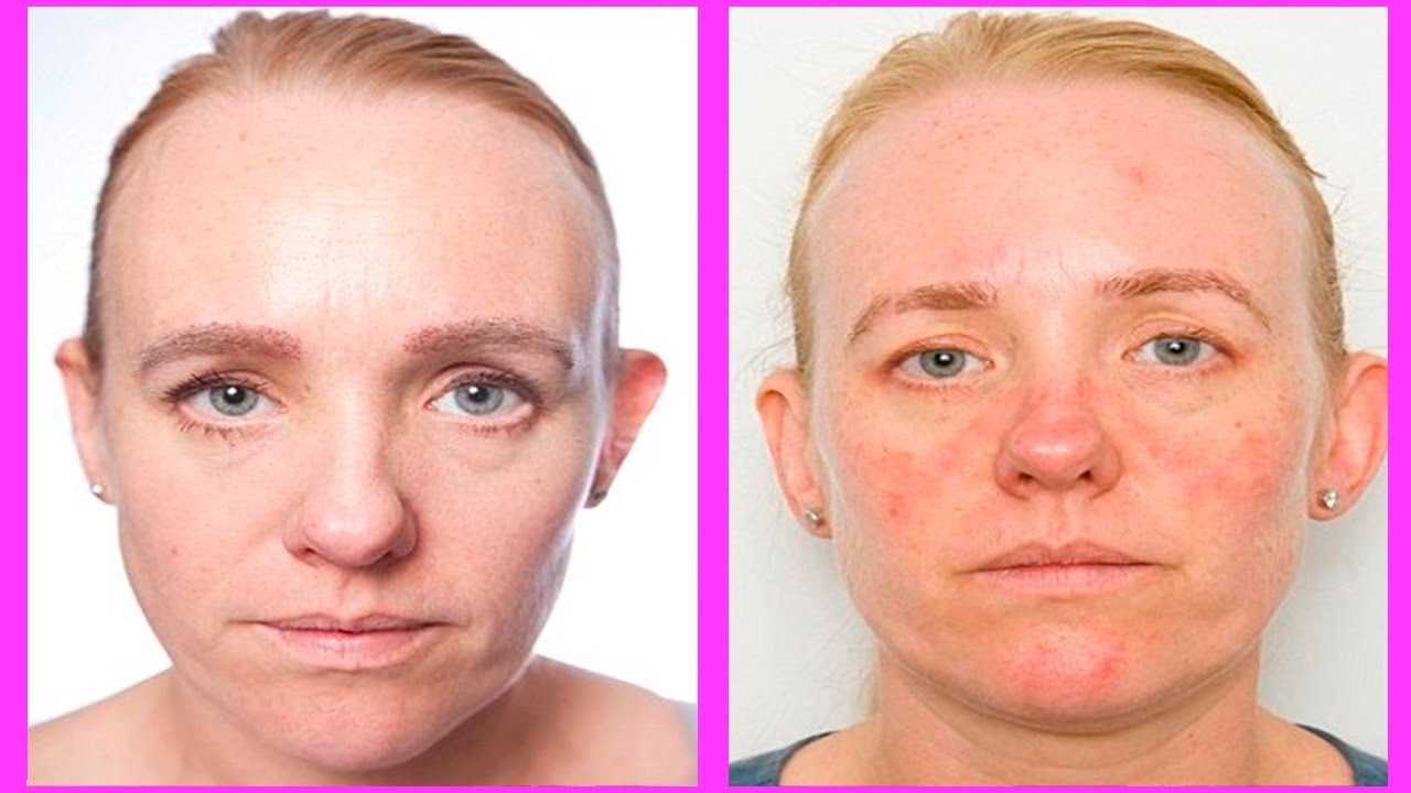 Как справиться с обезвоживанием кожи? | блог expert clinics