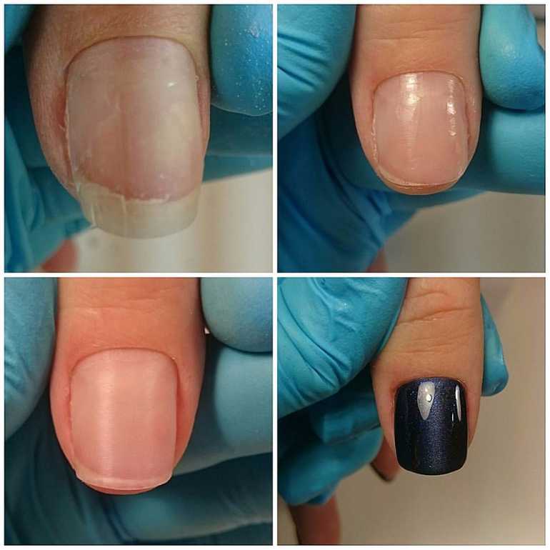 Что делать после снятия ногтя. Маникюр до и после. Комбинированный маникюр. Ногти до и после маникюра. Наращивание ногтевой пластины.