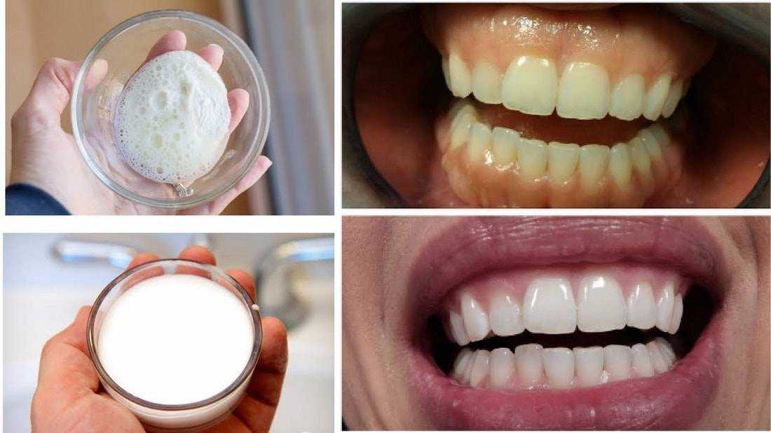 сода и зубная паста для отбеливания зубов