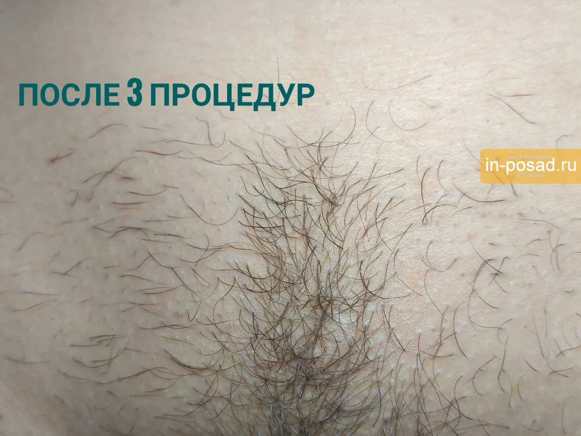 В чем разница между видами электроэпиляции  - unibeauty.ru
