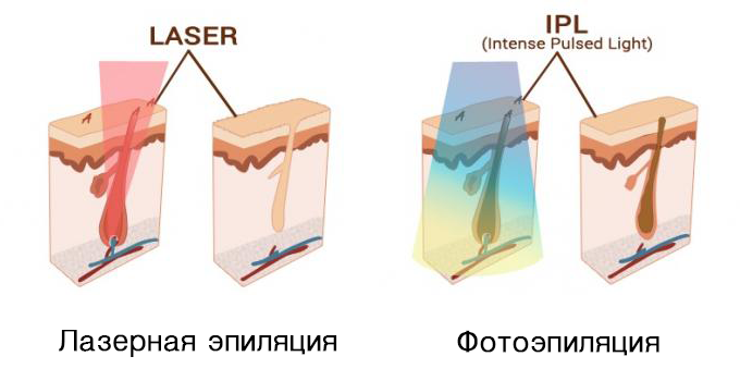 Вся правда про лазерную эпиляцию: часто задаваемые вопросы и заблуждения (lady mail.ru)