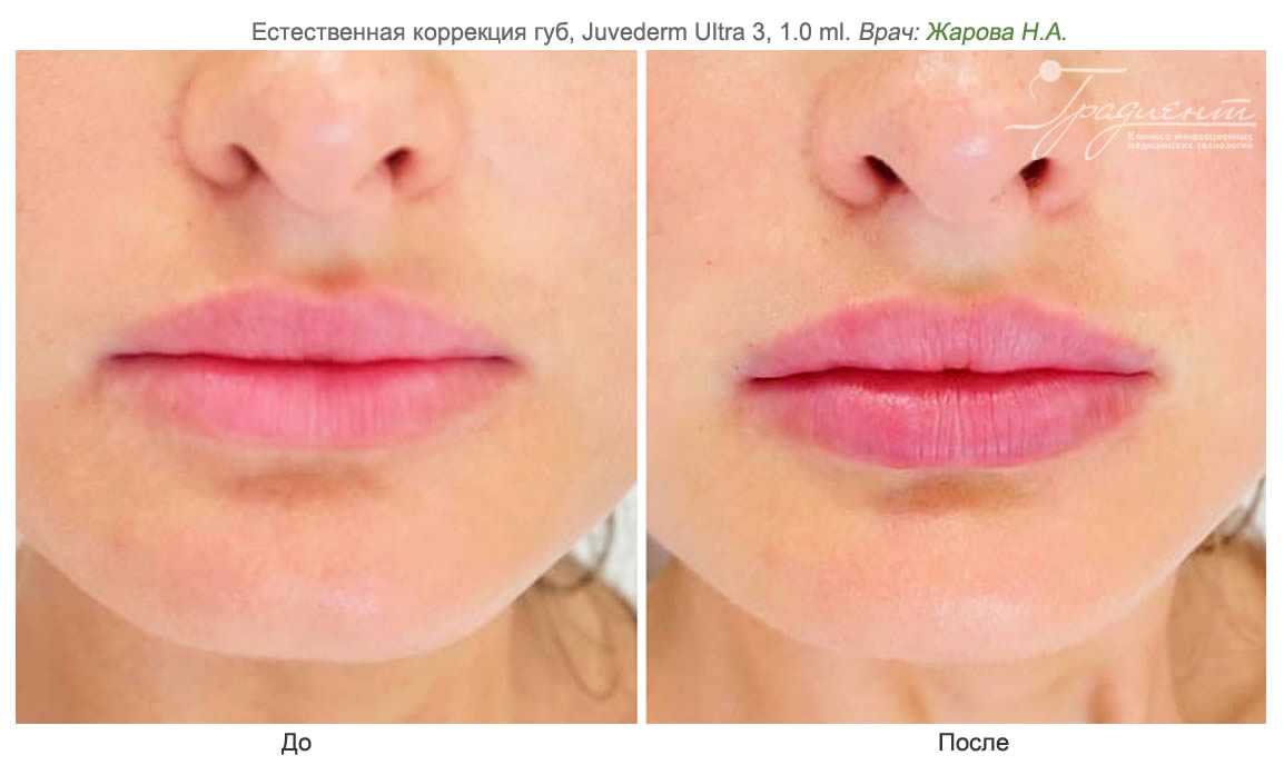 8 лучших увеличивающих блесков для губ