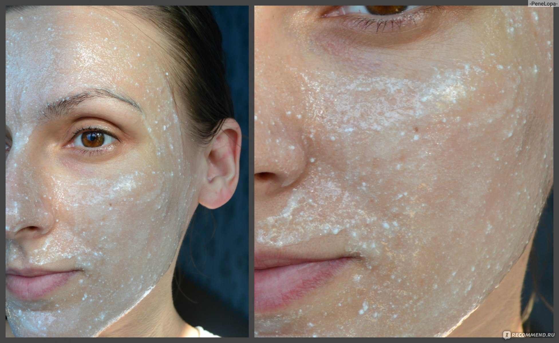 Аспириновая маска для лица: эффективное лечение самой проблемной кожи | women's talk