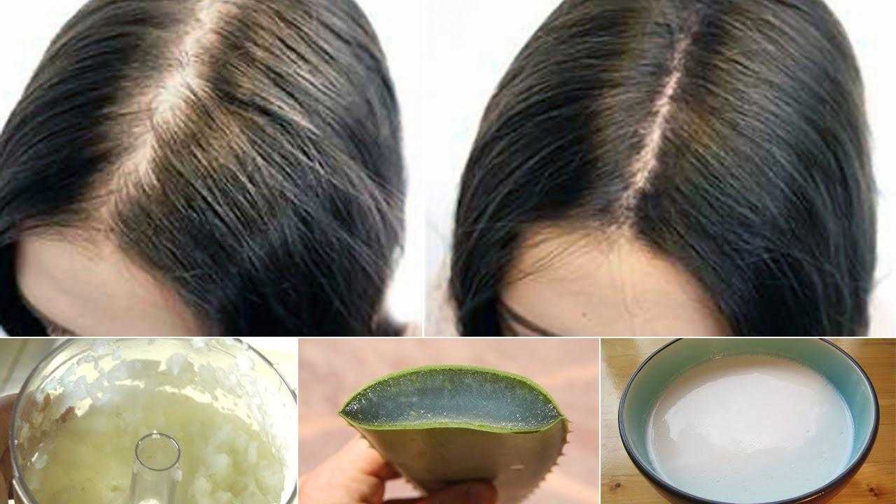 Выпадают волосы недостаток витамина. Средство от лысины у женщин. Маска для волос от залысин. Сильное выпадение волос. Маска от залысин для женщин.