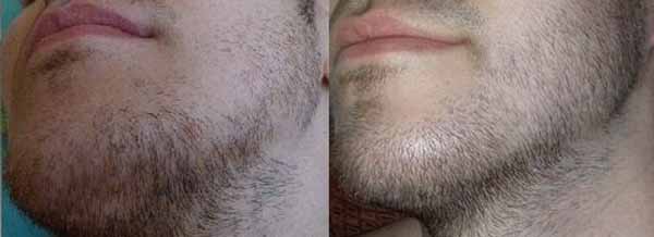 Как прекратить рост волос на лице у мужчин