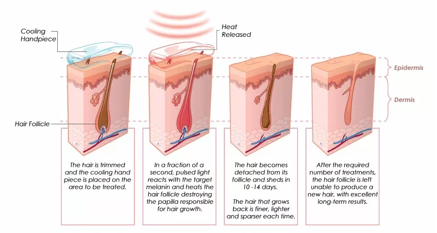 Нюансы лазерной эпиляции на разных частях тела. диодный и александритовый лазеры.