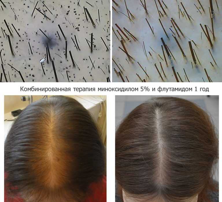 Что такое реактивное выпадение волос и как с ним бороться?